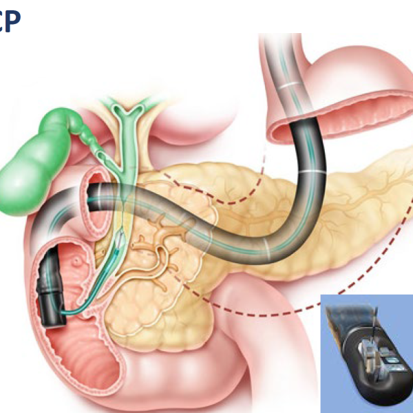 ERCP